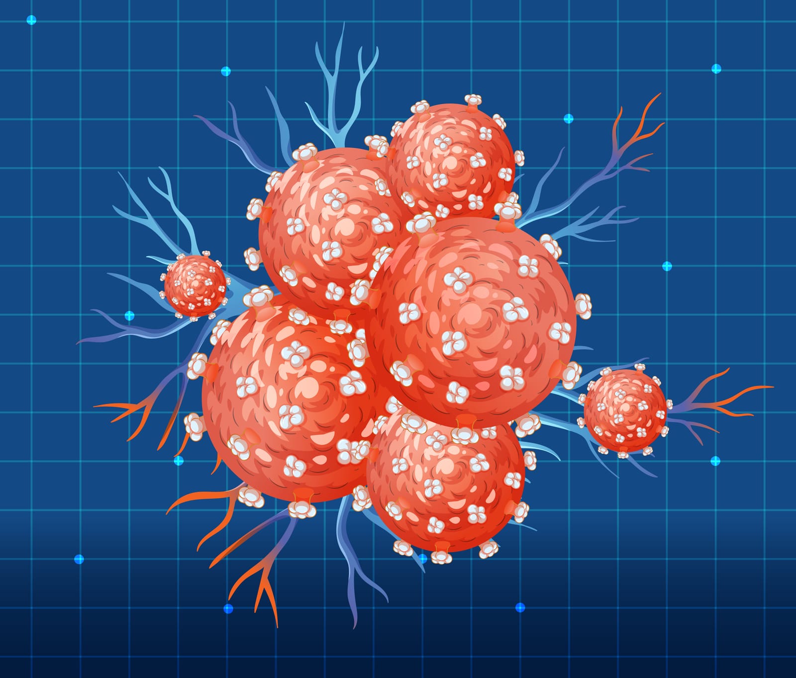Stadiile cancerului rectal: ce inseamna stadiul I, II, III si IV